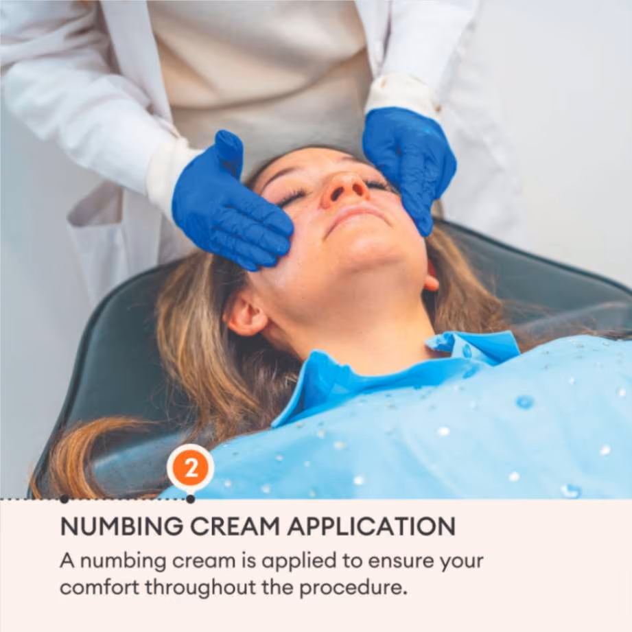 Microneedling 4