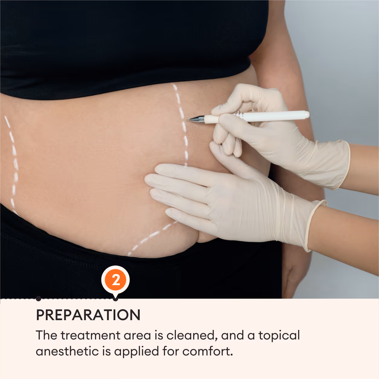 Laser Lipolysis Body 5
