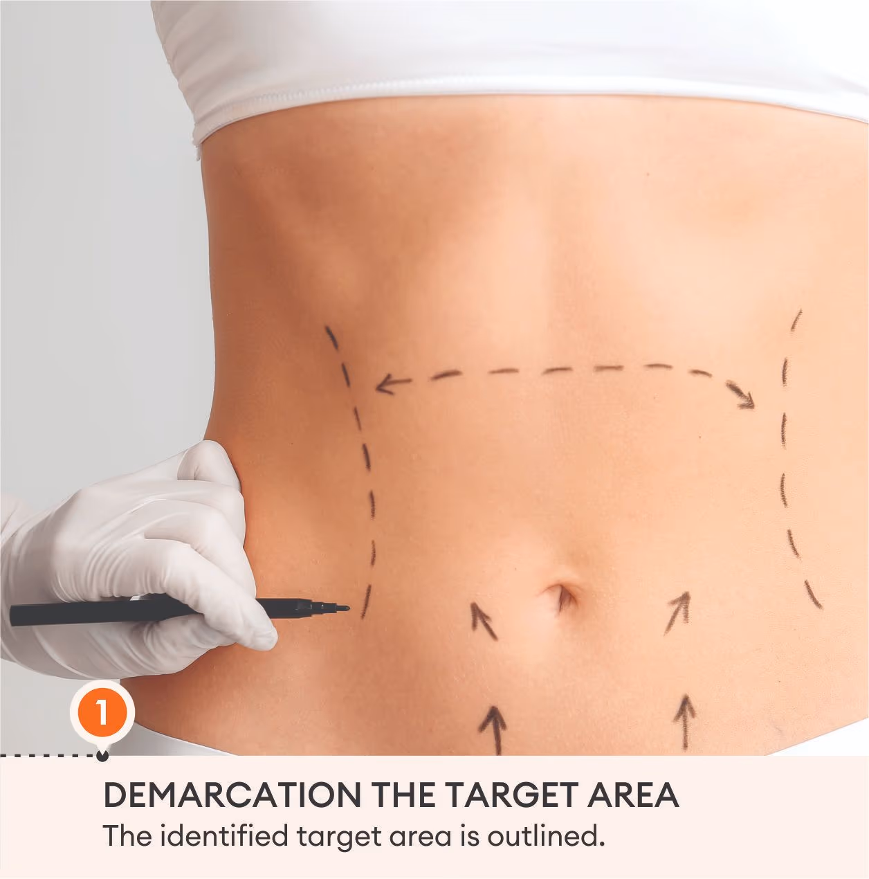 Cryolipolysis (Coolsculpting) Fat Removal 4