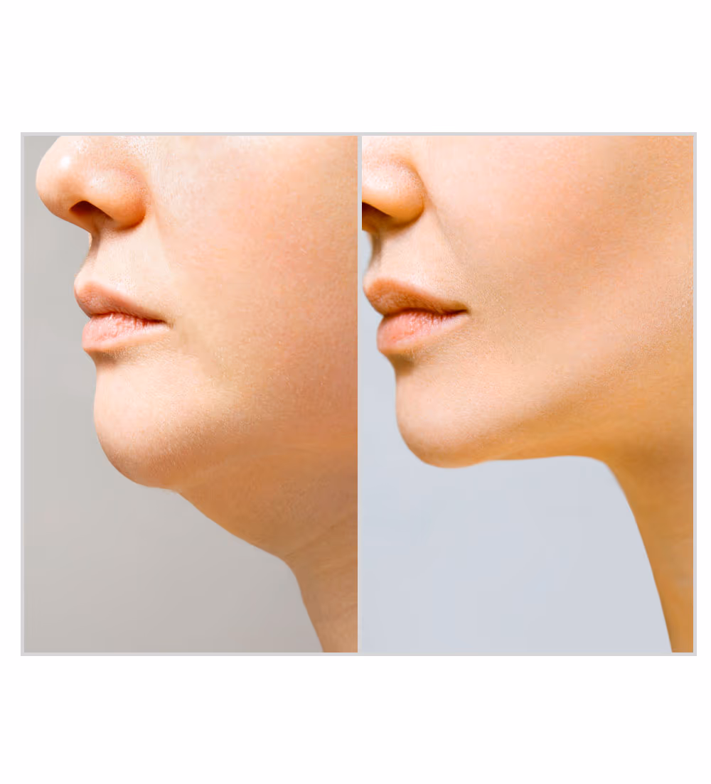 Lypolysis 1