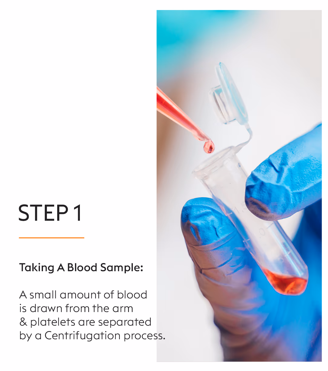 PRP Treatment for Face: Platelet Rich Plasma Therapy at VLCC 3