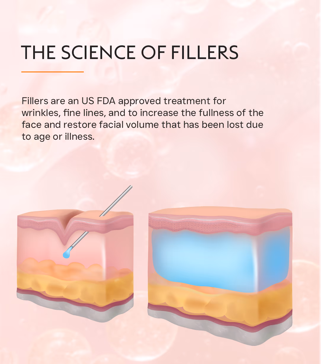 Face Fillers Injection Treatment 2
