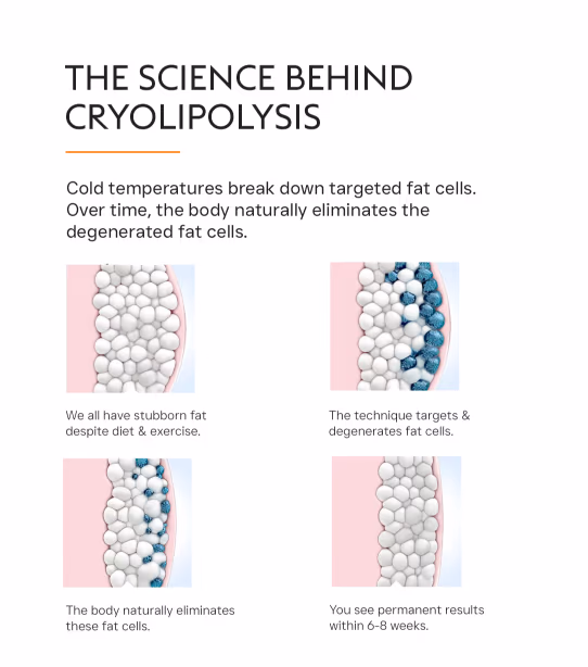 Cryolipolysis (Coolsculpting) Fat Loss Treatment 3
