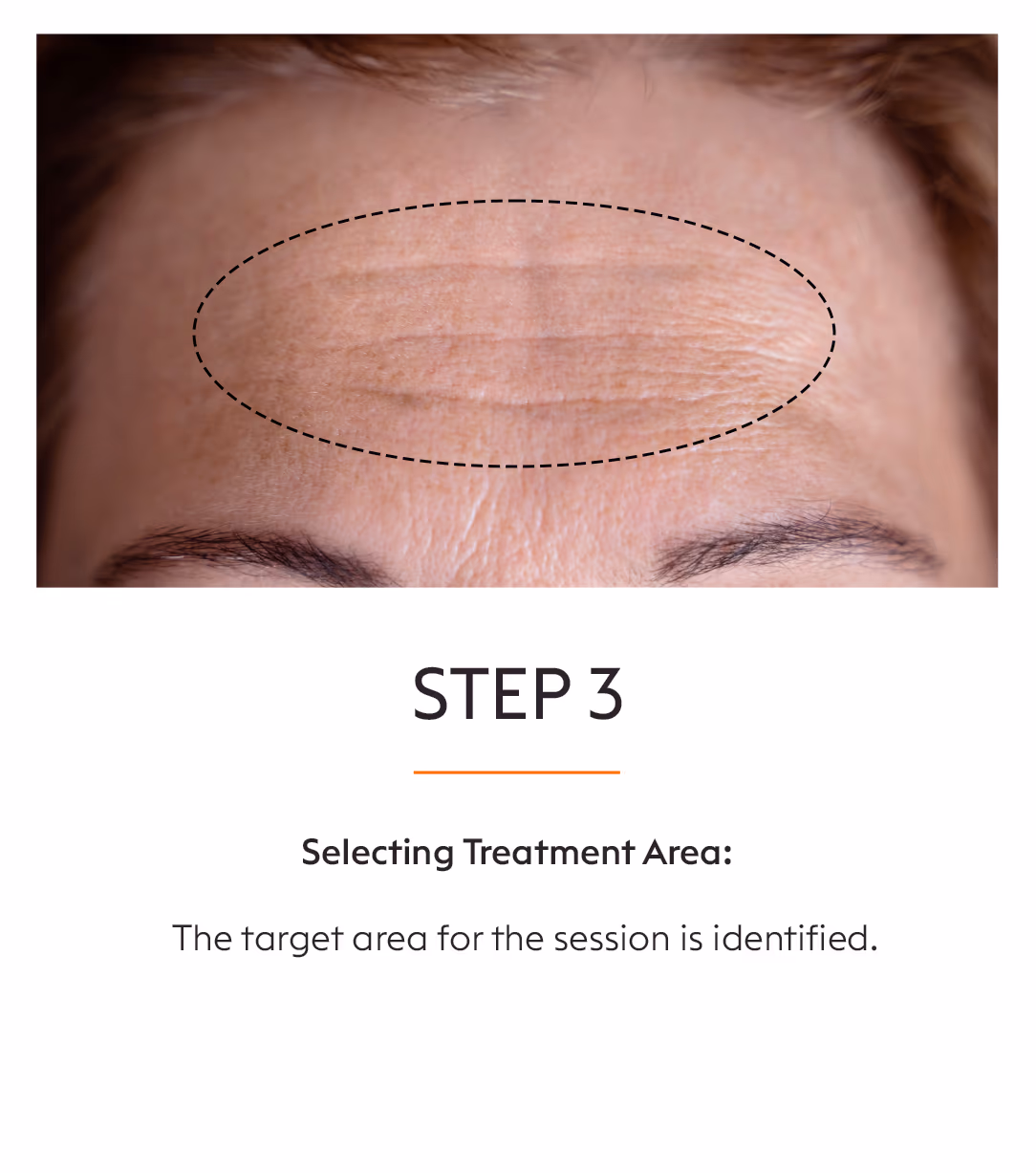 Microneedling and RF 5