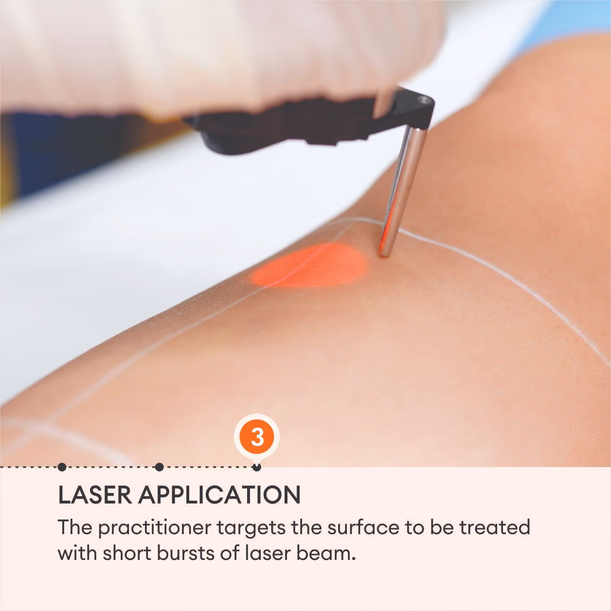 Laser Hair Reduction 5