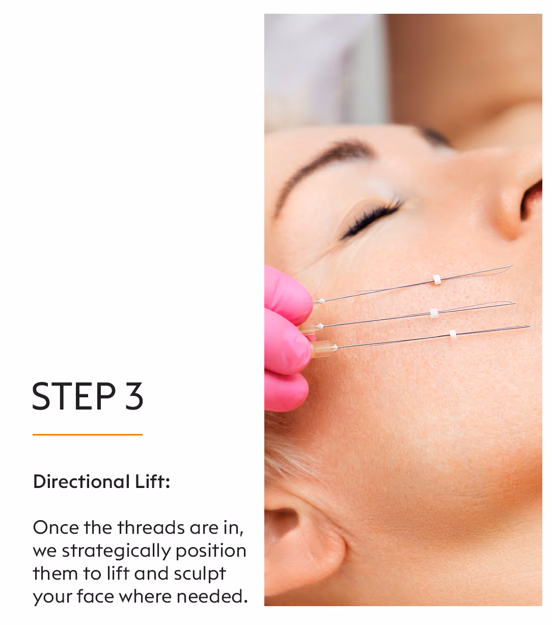 Thread Lift 5