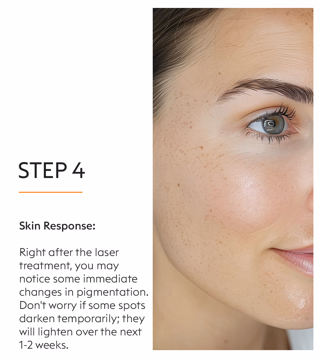 Nd Yag Laser Pigmentation Treatment 6