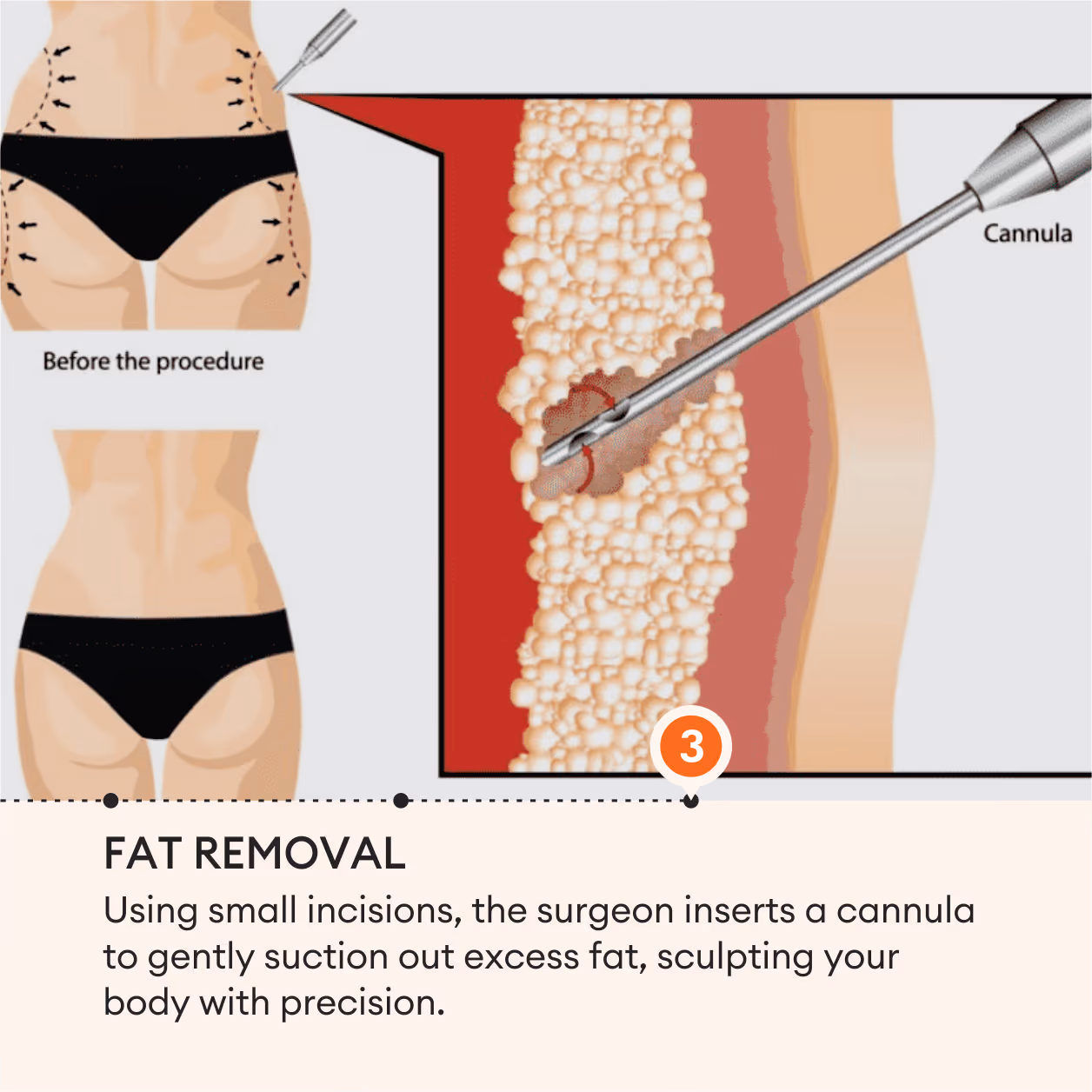 Liposuction Surgery 6