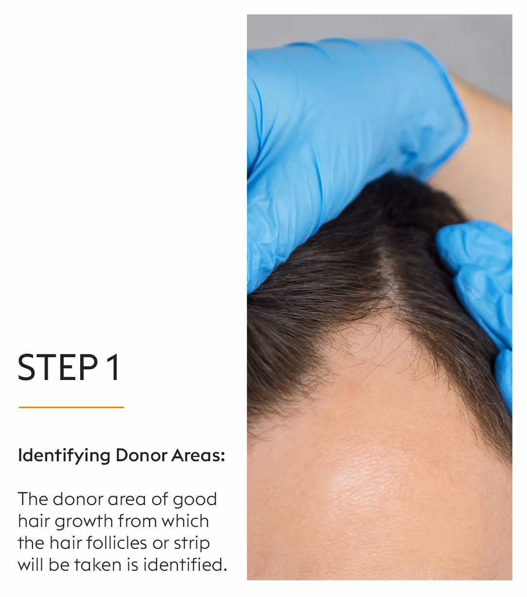 Hair Transplant Hair Fall Treatment 3