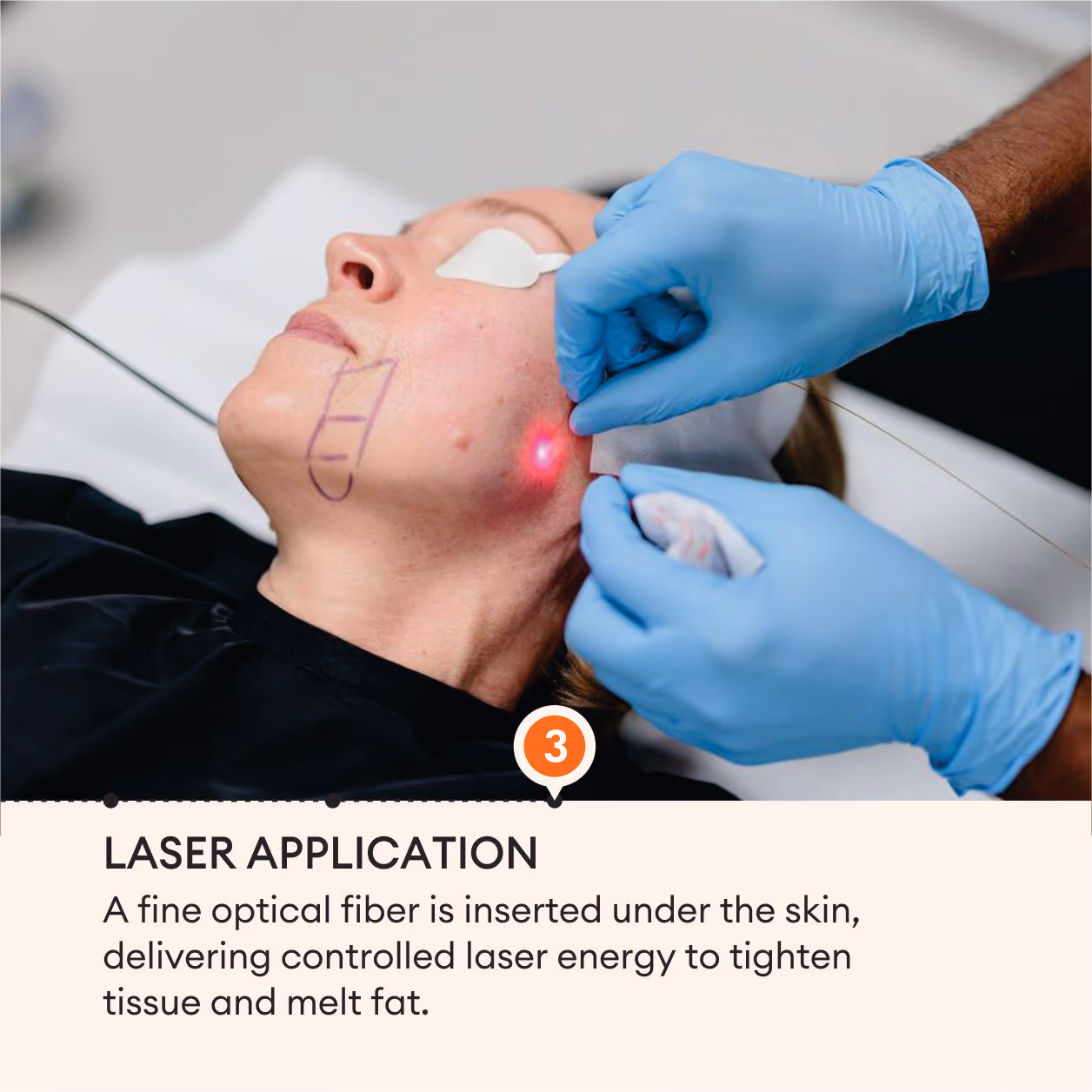 Laser Lipolysis Face 6