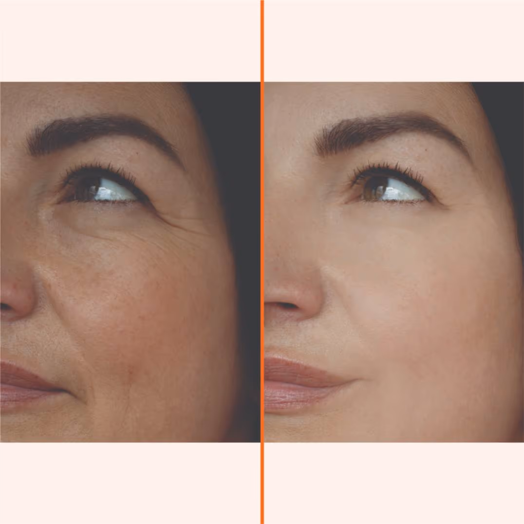 Dermal Fillers 1