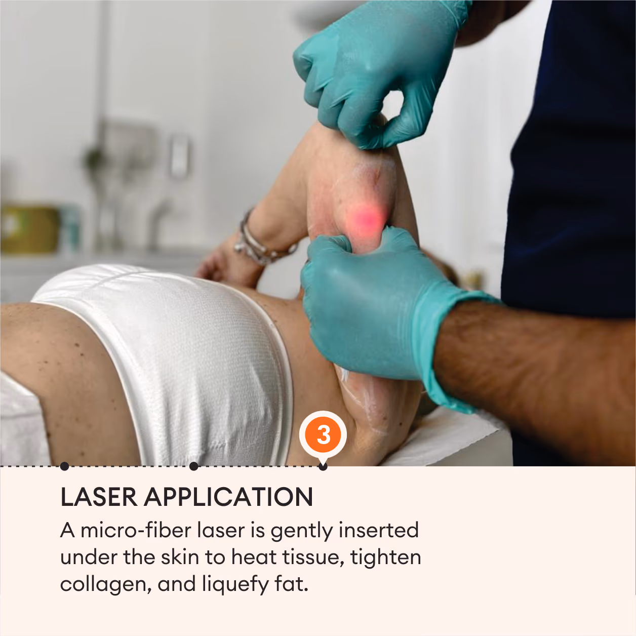 Laser Lipolysis Body 6