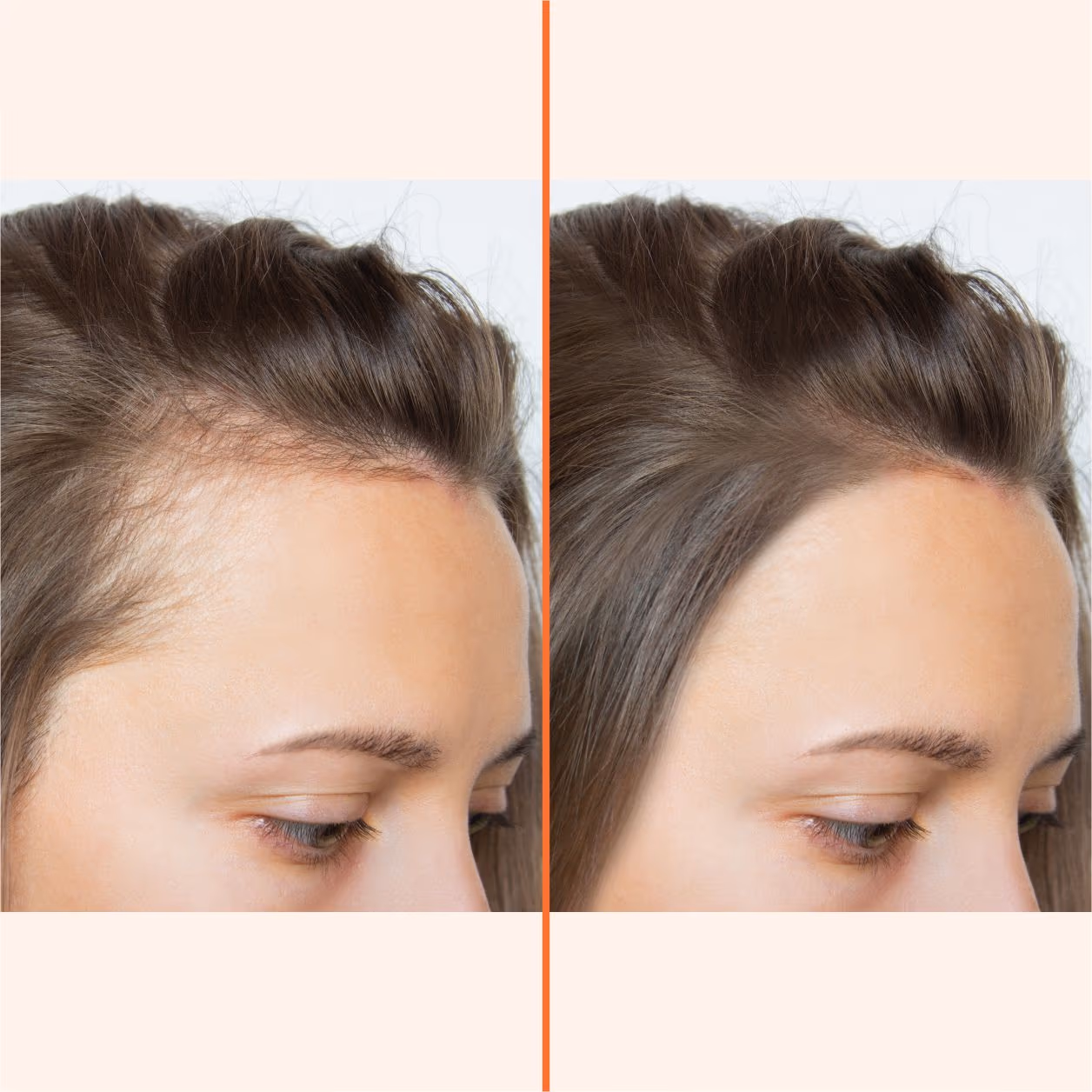 Indiba Hair 1