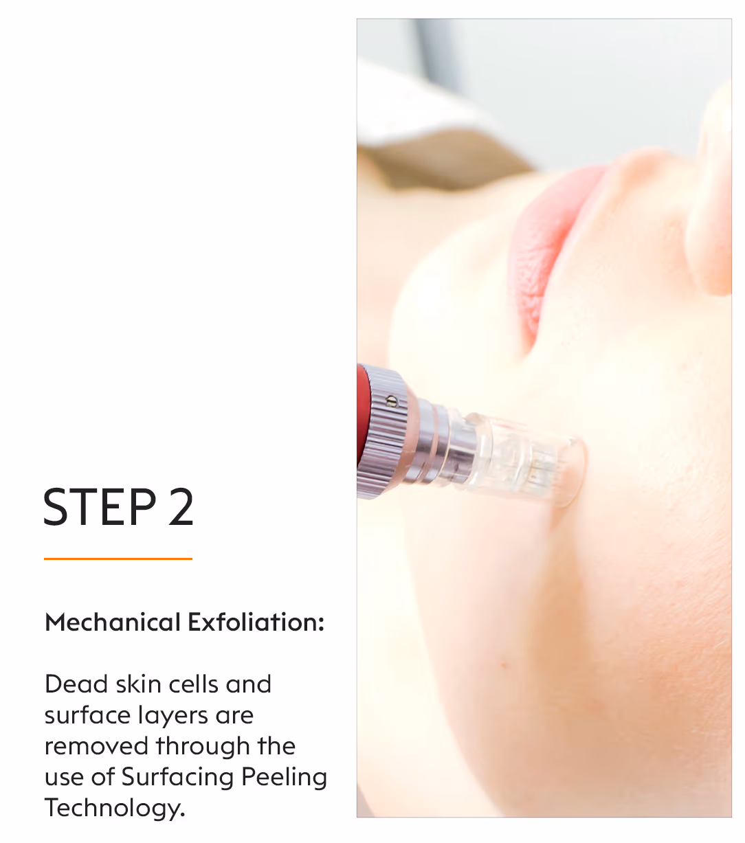 Enzymacid Peel 4