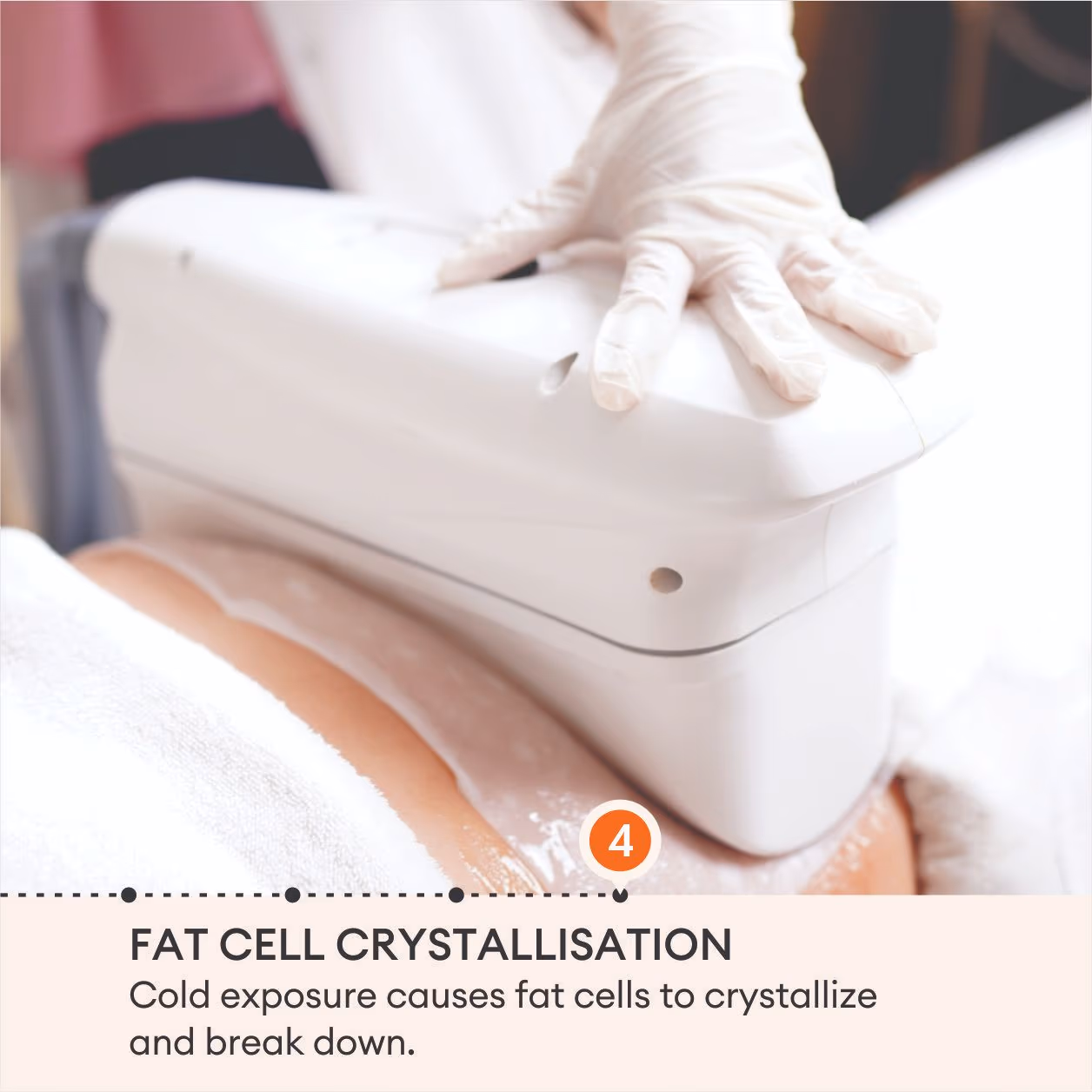 Cryolipolysis (Coolsculpting) Fat Removal 7