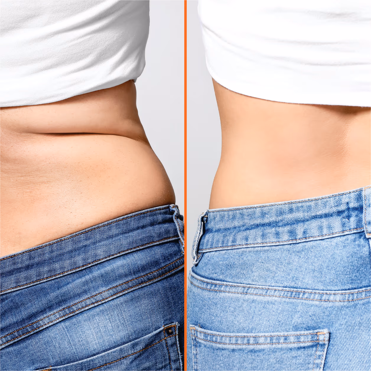 Laser Lipolysis Body 2