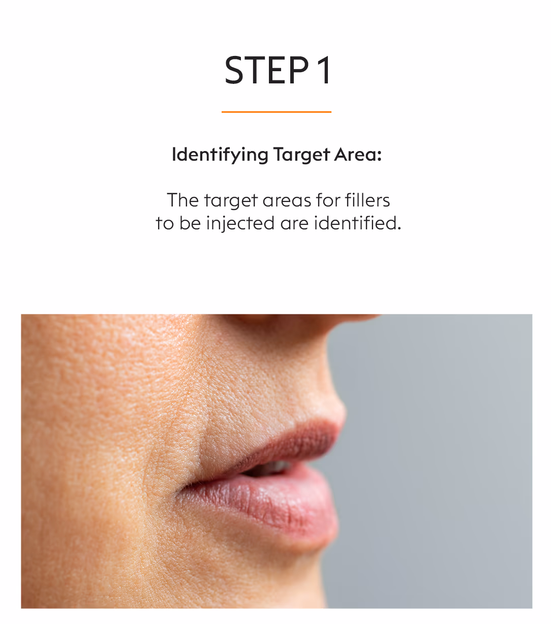 Face Fillers Injection Treatment 3