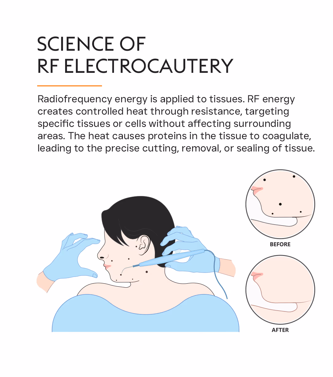 RF Electrocautery 2