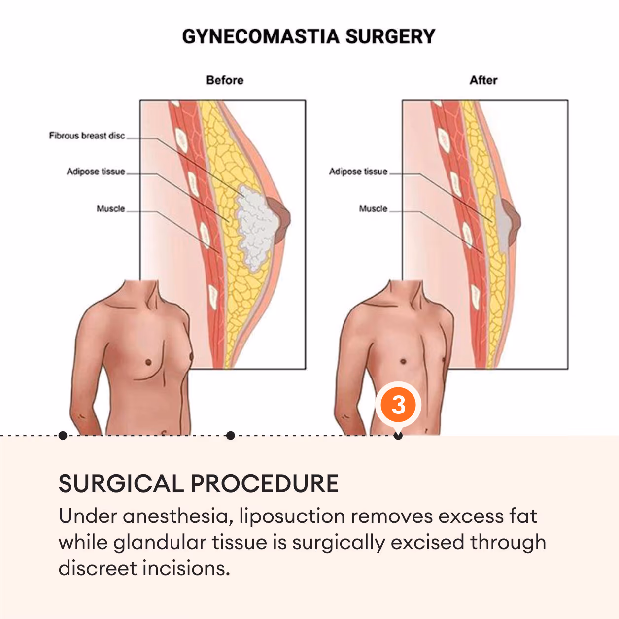 Gynecomastia Surgery 6