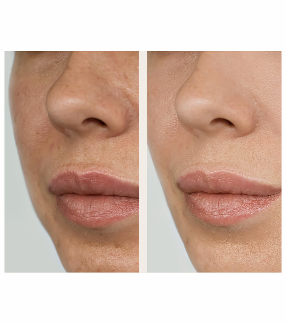 Microneedling and RF 1