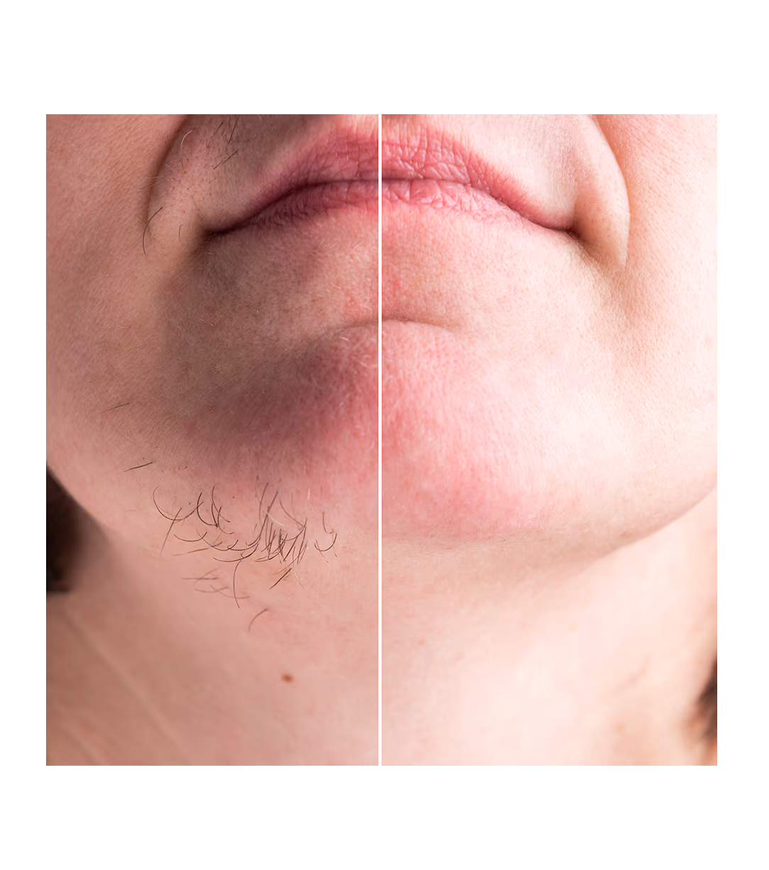 Full Body Laser Hair Removal Treatment 1