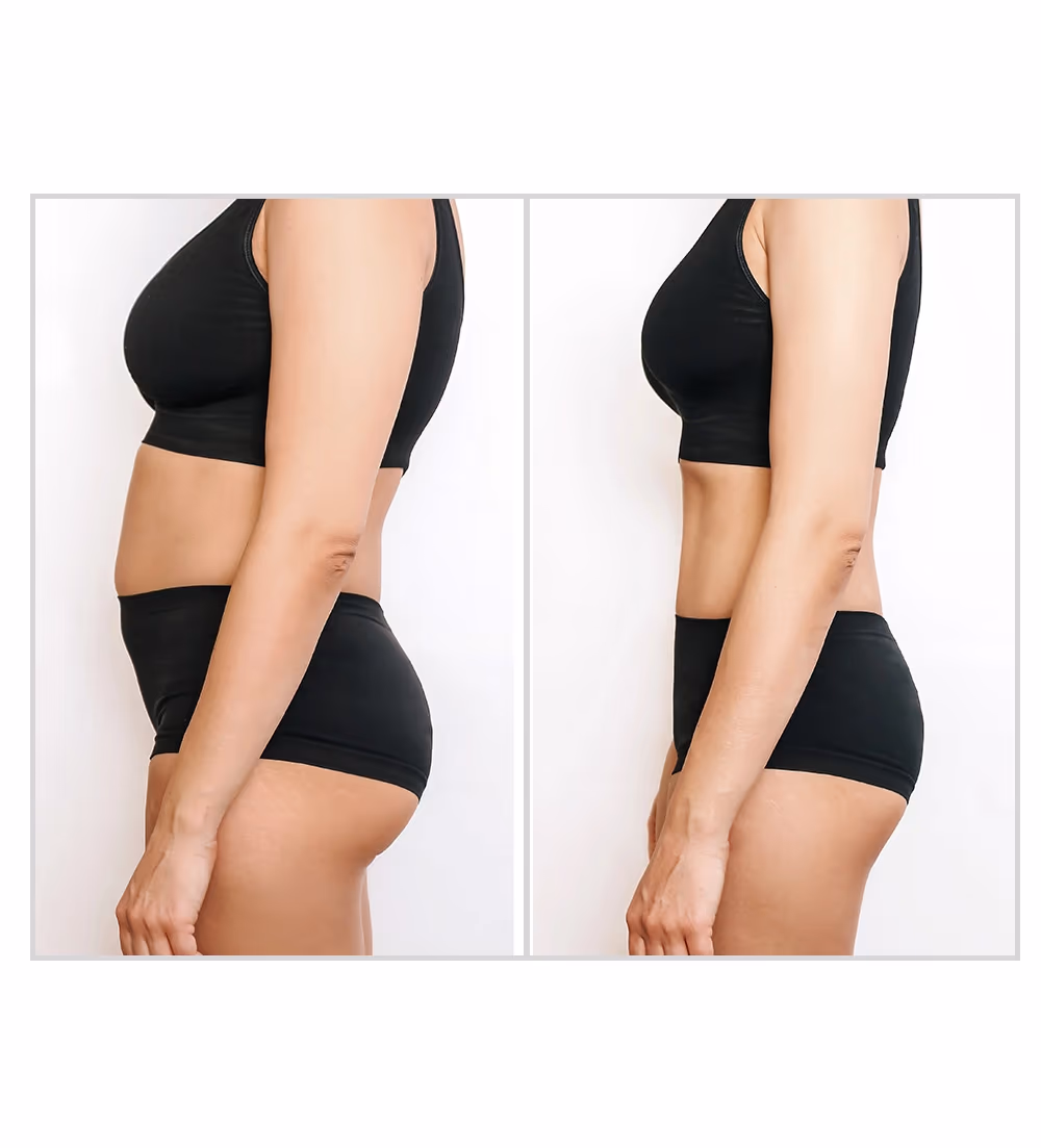 Fat Loss Zerona Laser Treatment 1
