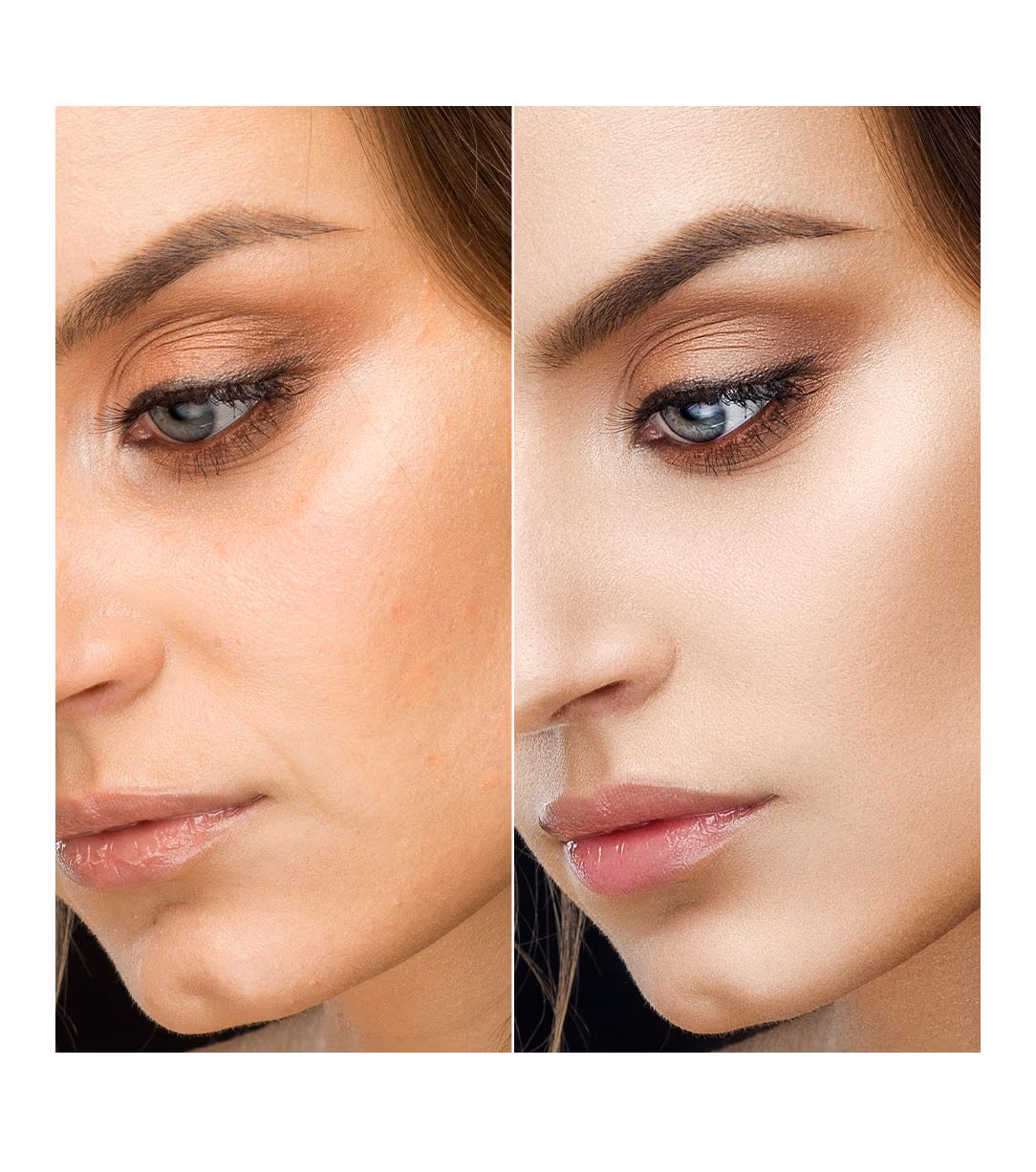 Derma Roller Microneedling Treatment 1