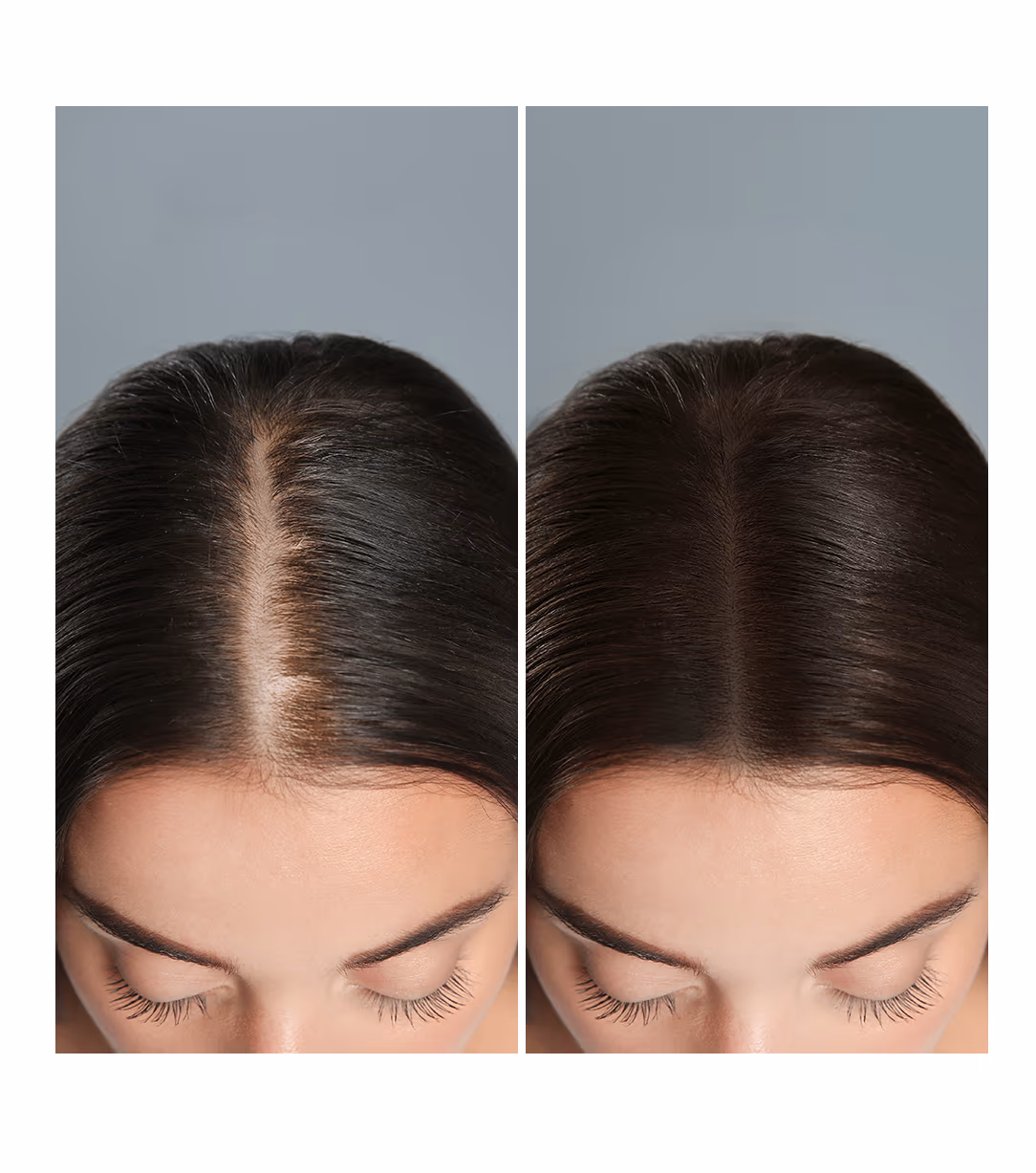 Meso Scalp 1