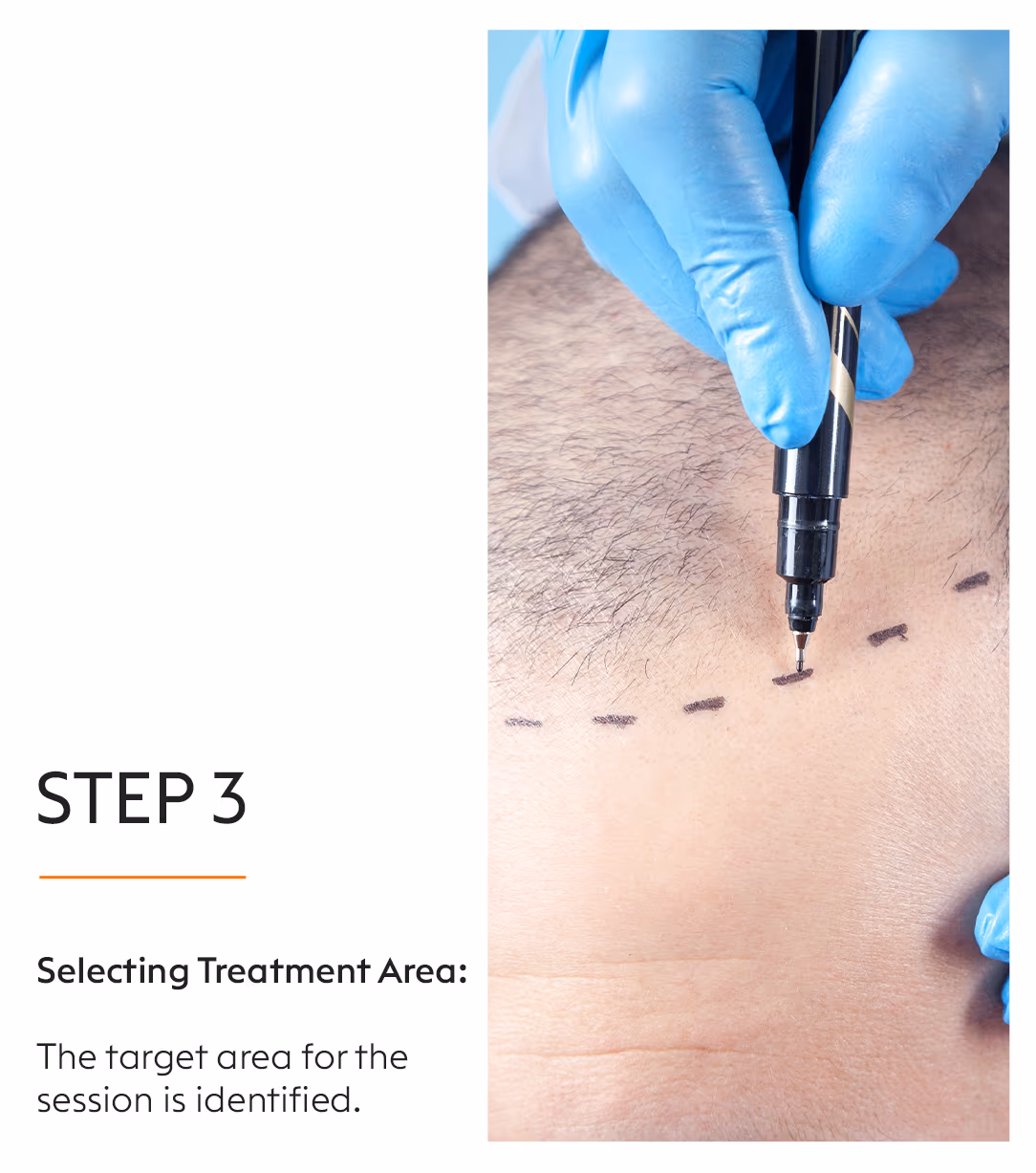 PRP Hair Fall Treatment 5