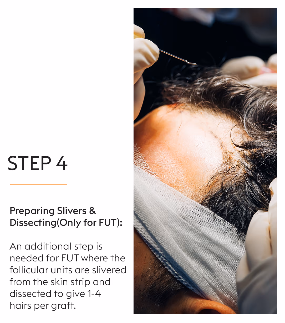 Hair Transplant Hair Fall Treatment 6