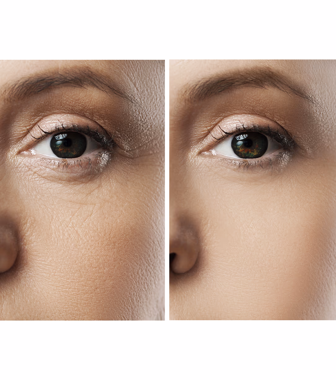 Hifu Facial Skin Tightening Treatment 1