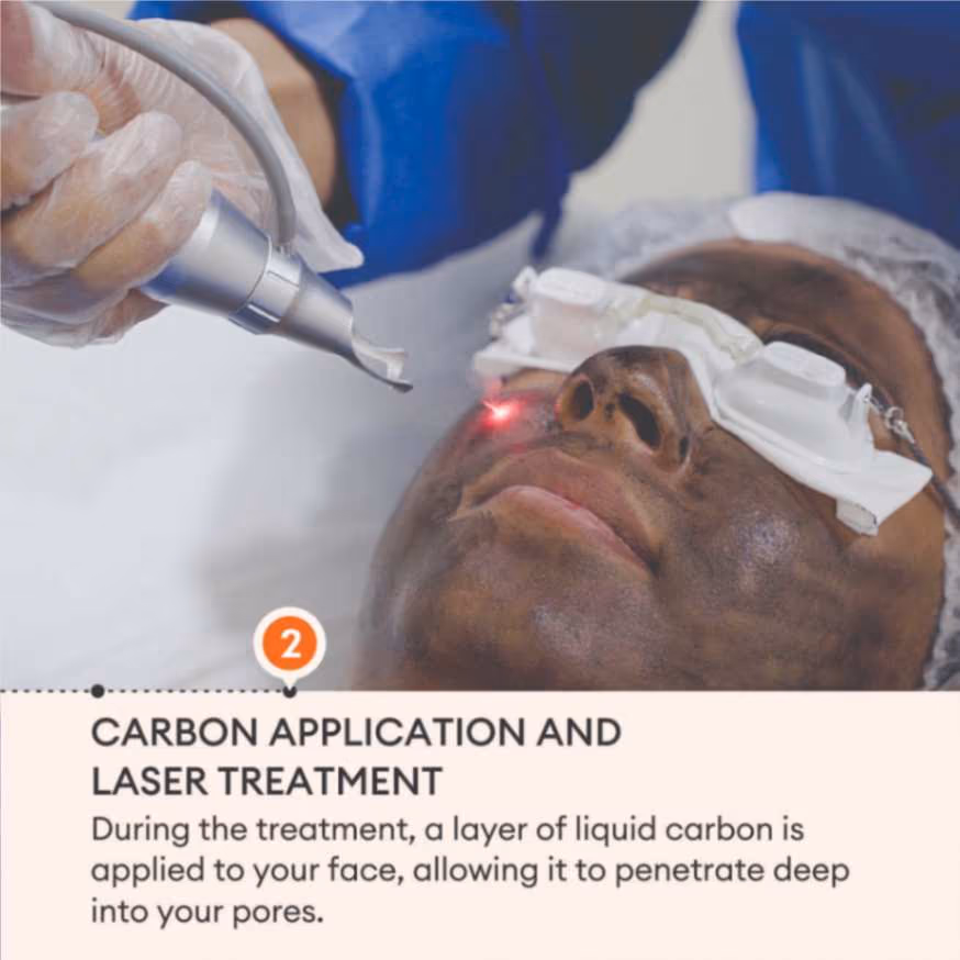Carbon Laser Peel 4