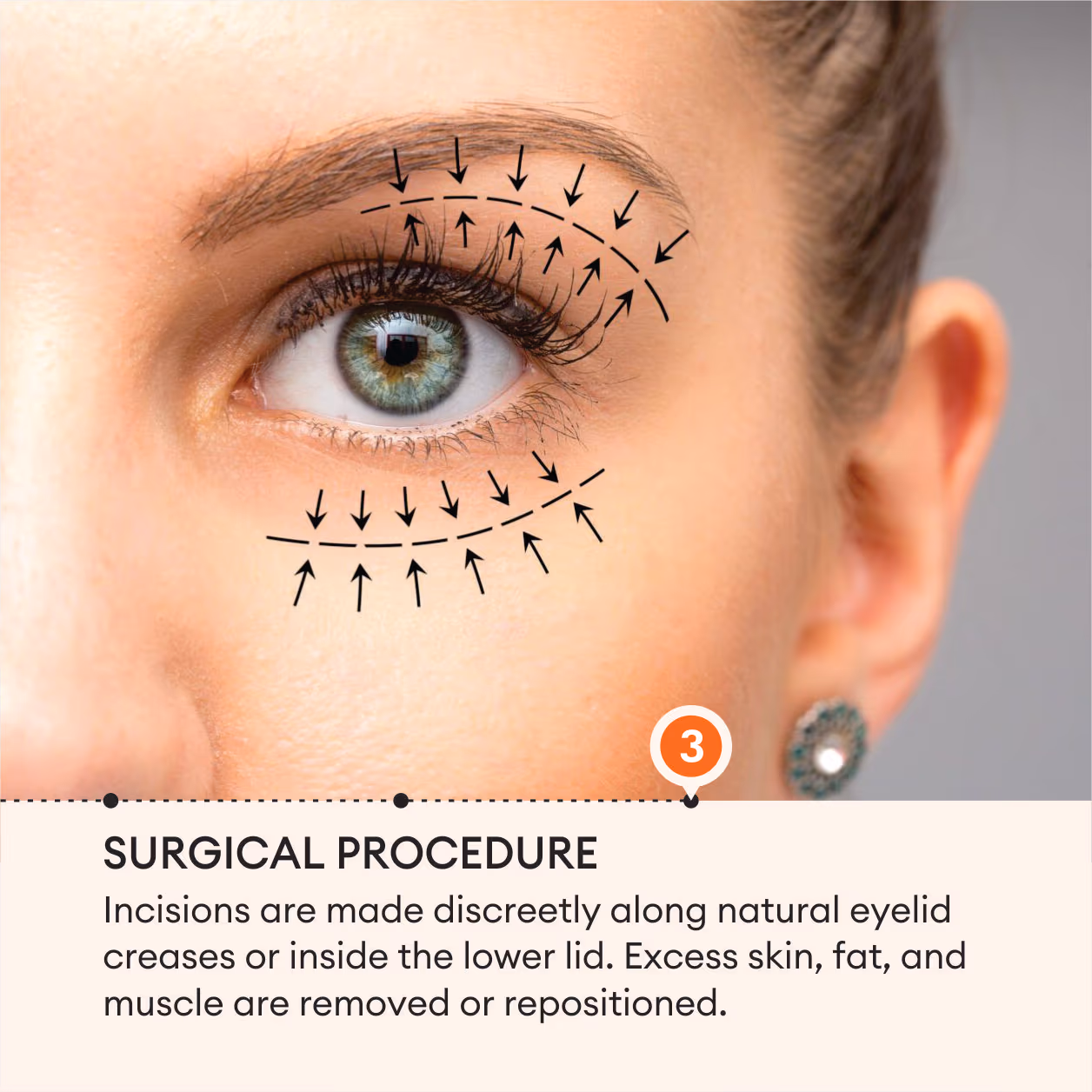 Dermafrac Skin Infusion 6