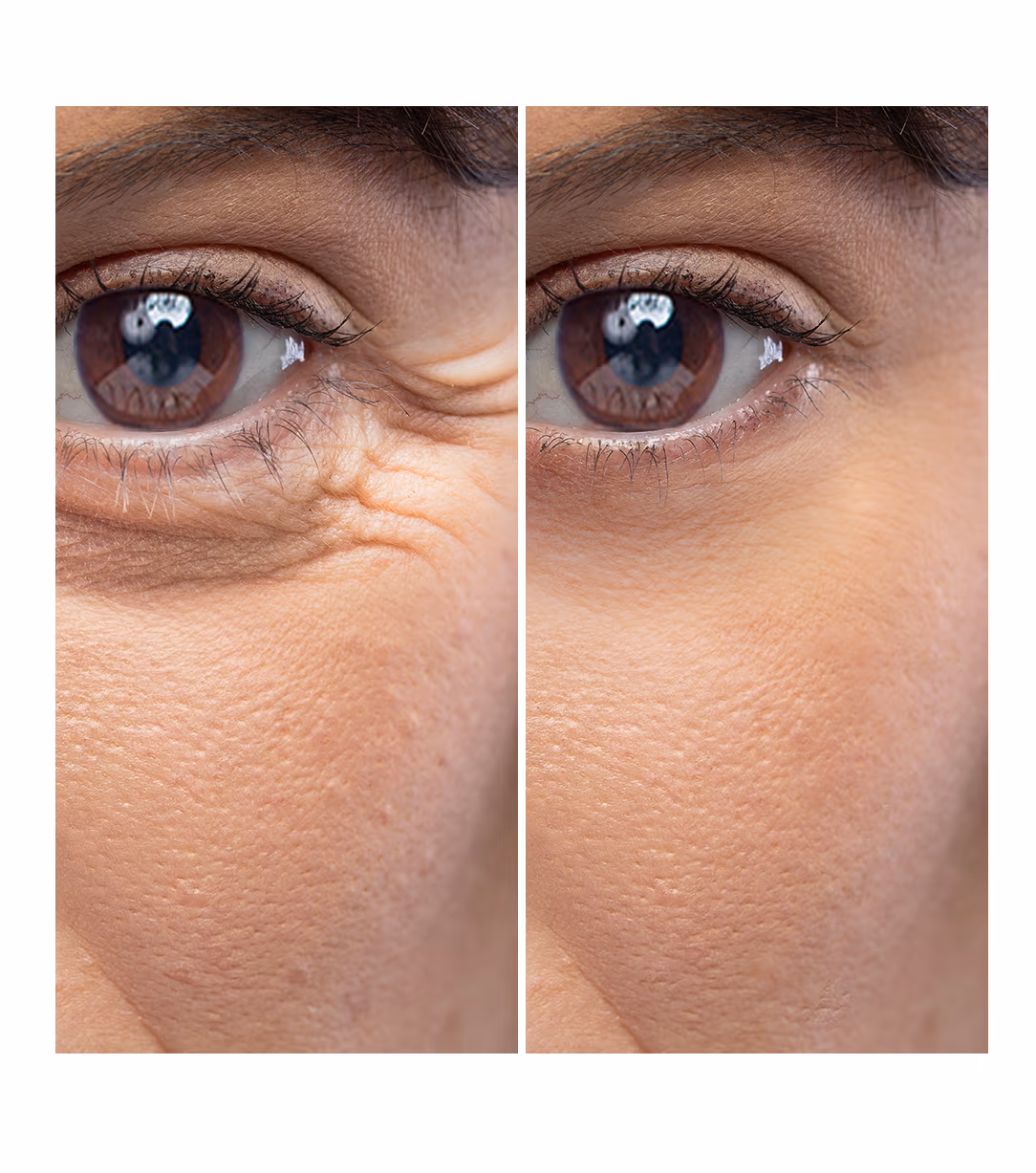 Mesobotox 1