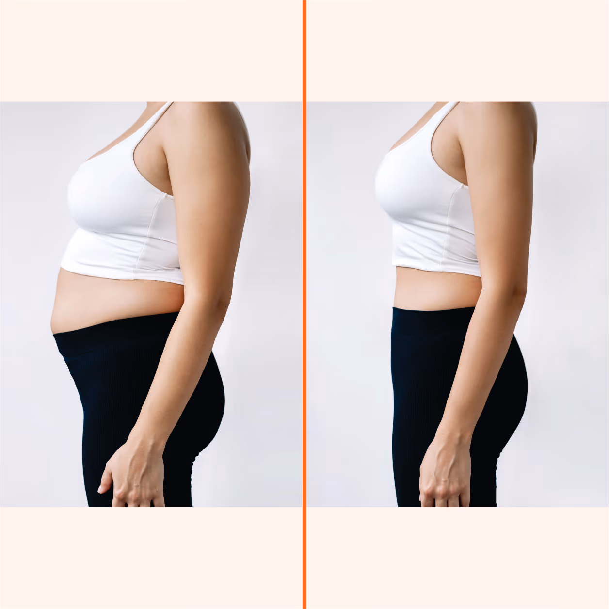 Tummy Tuck Surgery (Abdominoplasty) 1