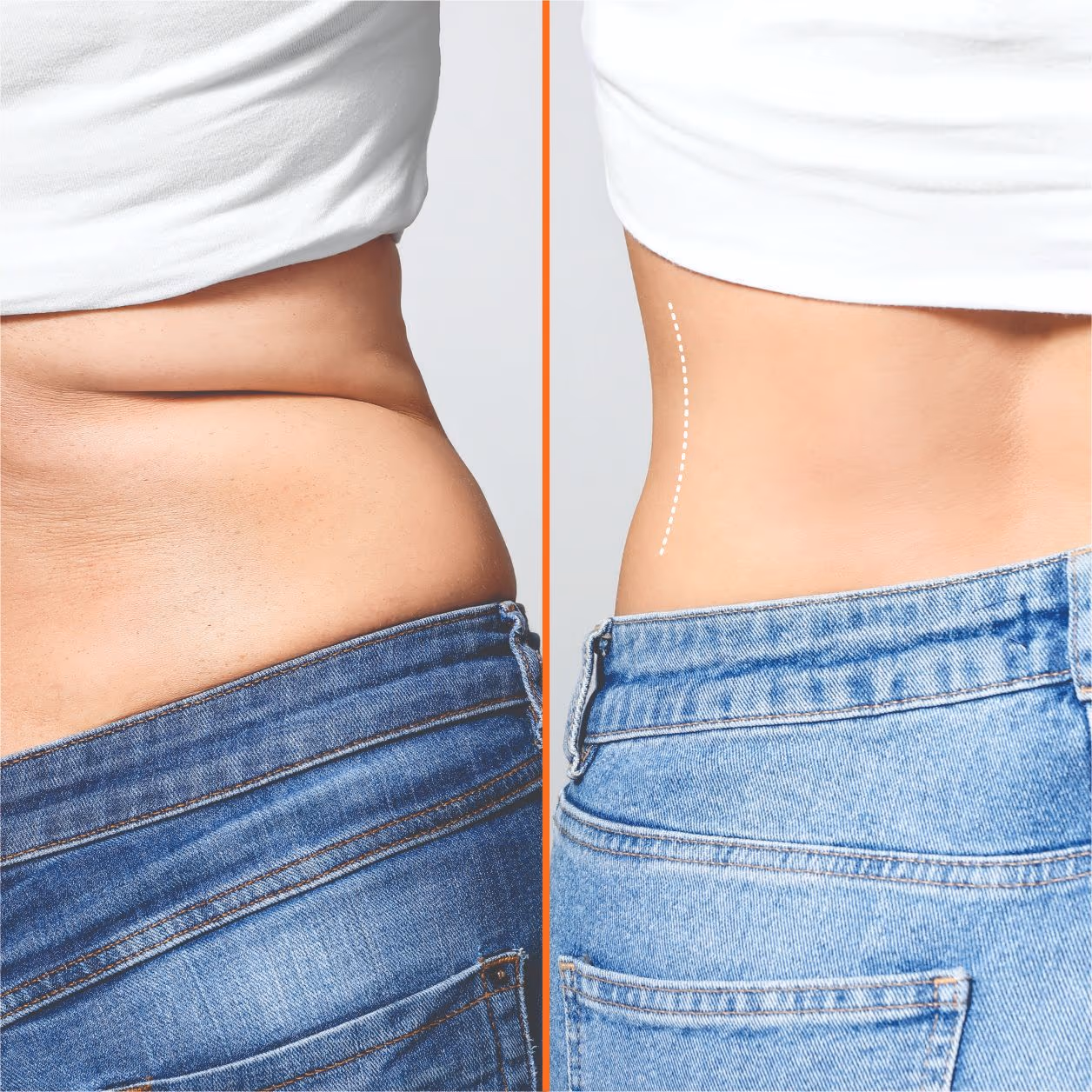 Cryolipolysis (Coolsculpting) Fat Removal 1