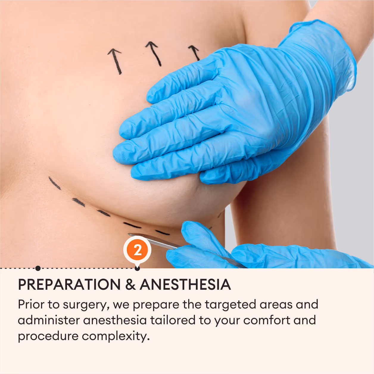 Breast Lift (Mastopexy) Surgery 5