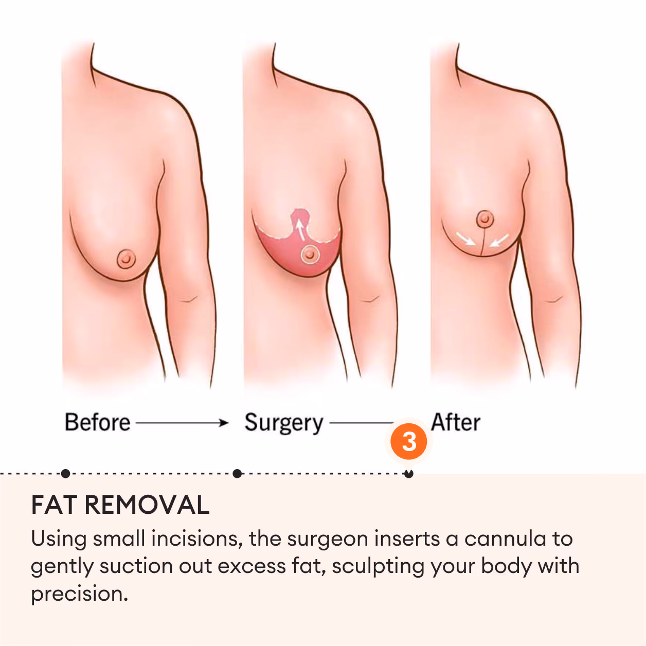 Breast Lift (Mastopexy) Surgery 6