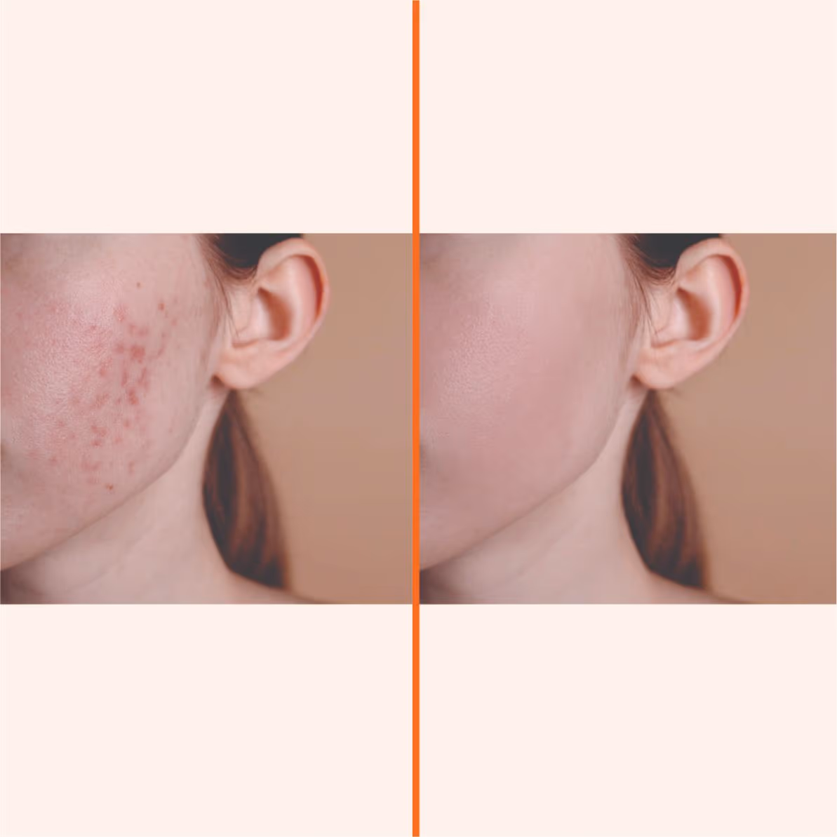 Carbon Laser Peel 1