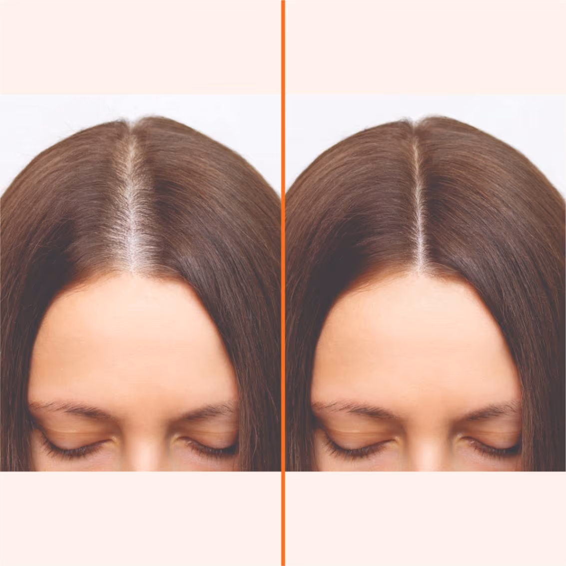 Mesotherapy 1
