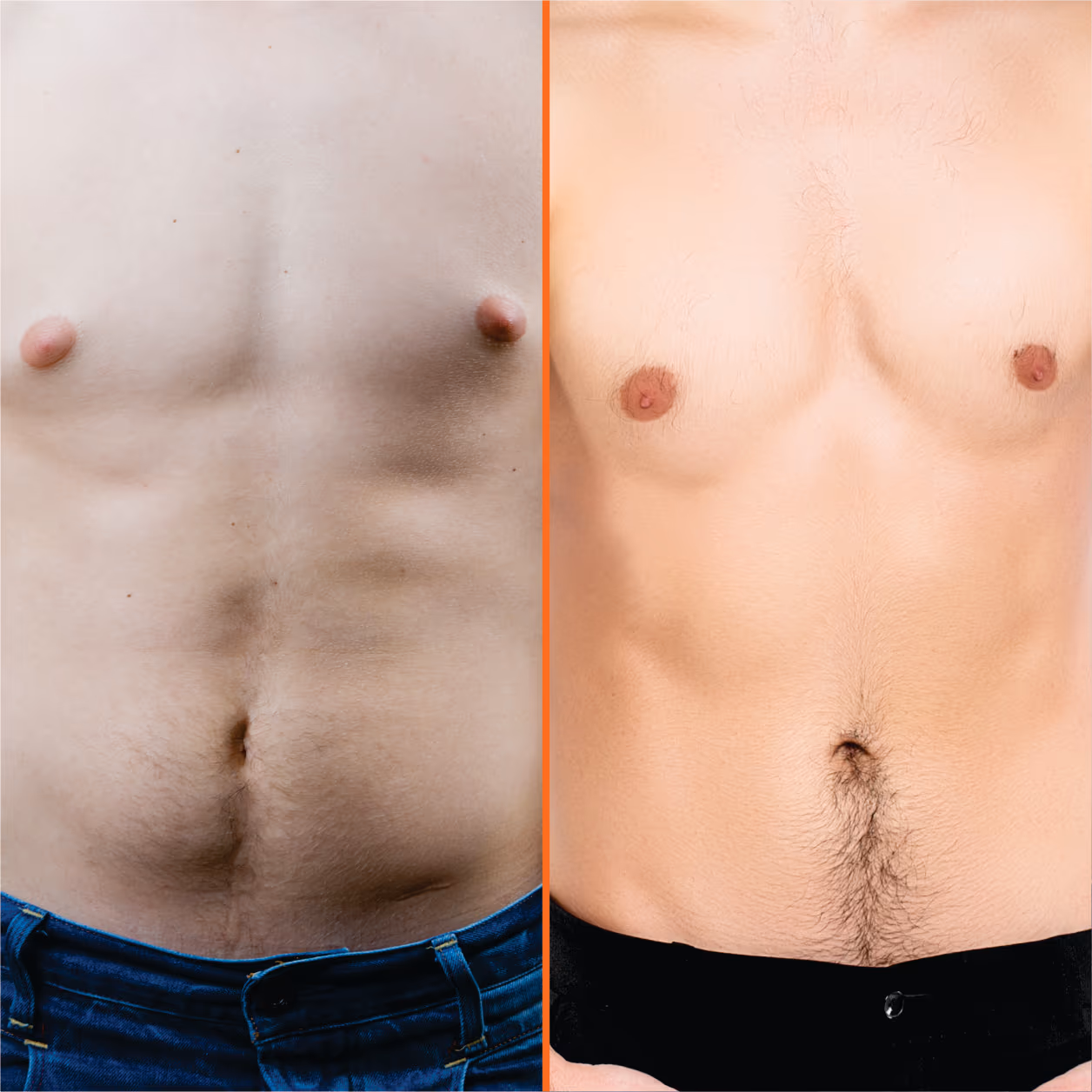 Gynecomastia Surgery 2
