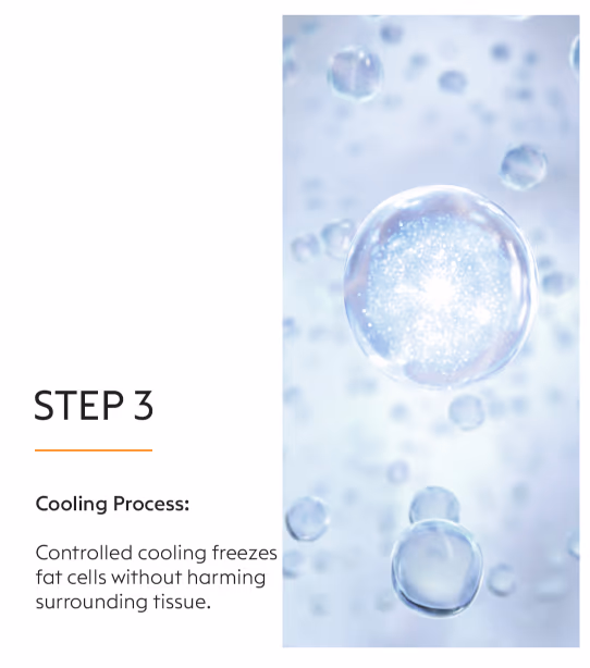 Coolsculpting Fat Loss Treatment 7