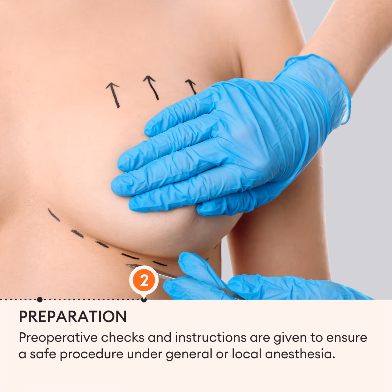 Breast Augmentation (Mammoplasty) 5
