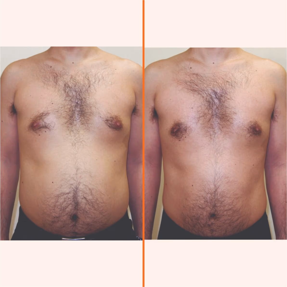 Indiba Body 1