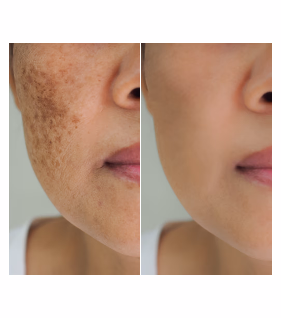 Tubelite Micro Peel Skin Whitening Treatment 1