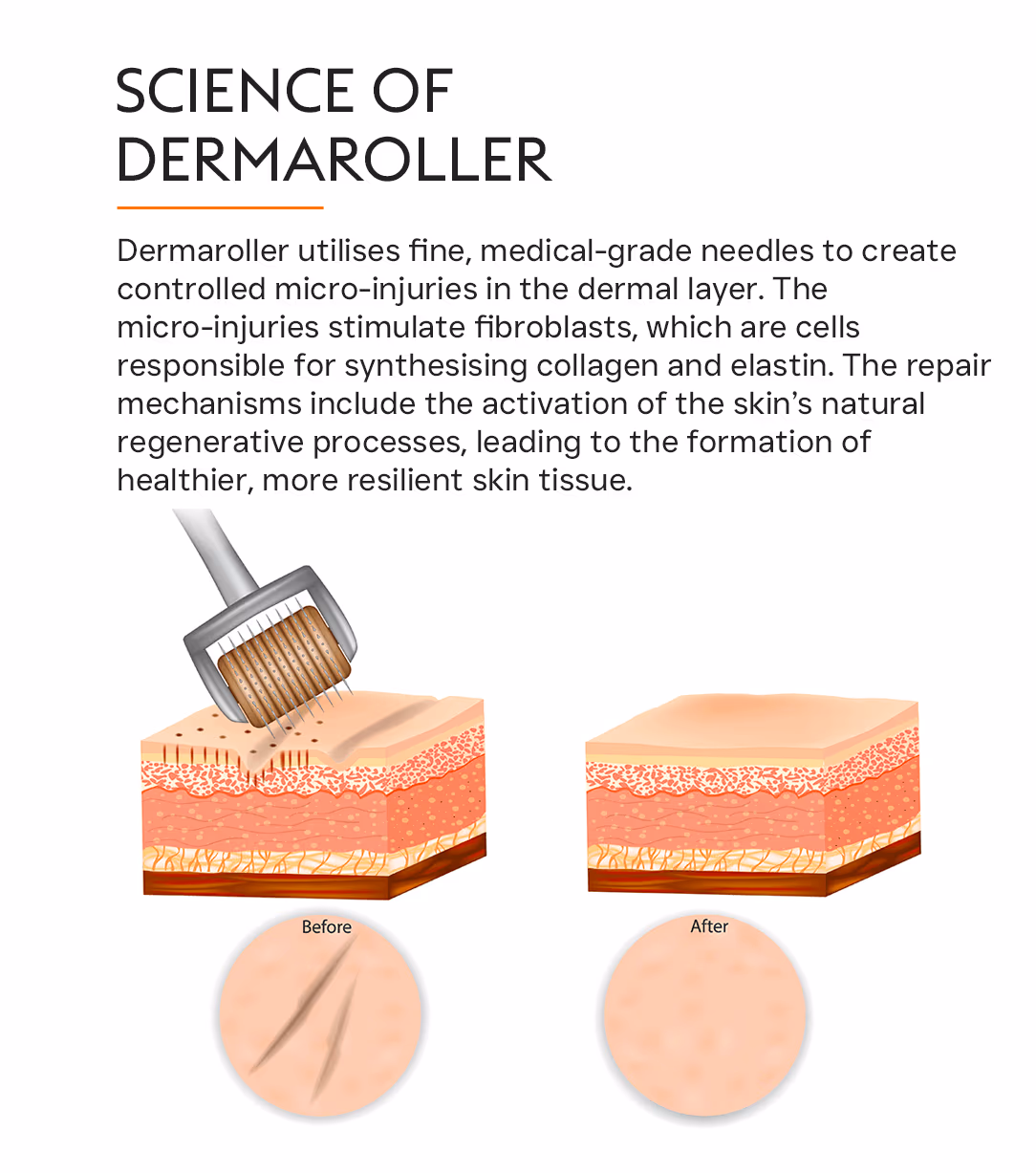 Derma Roller Microneedling Treatment 2