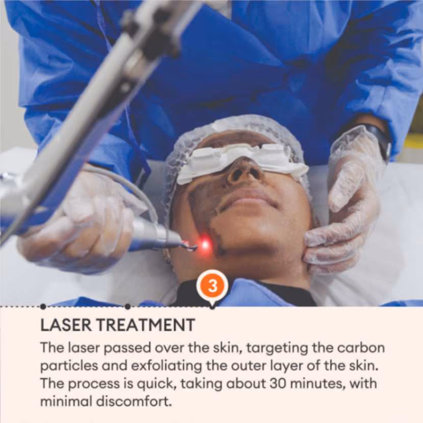 Carbon Laser Peel 5