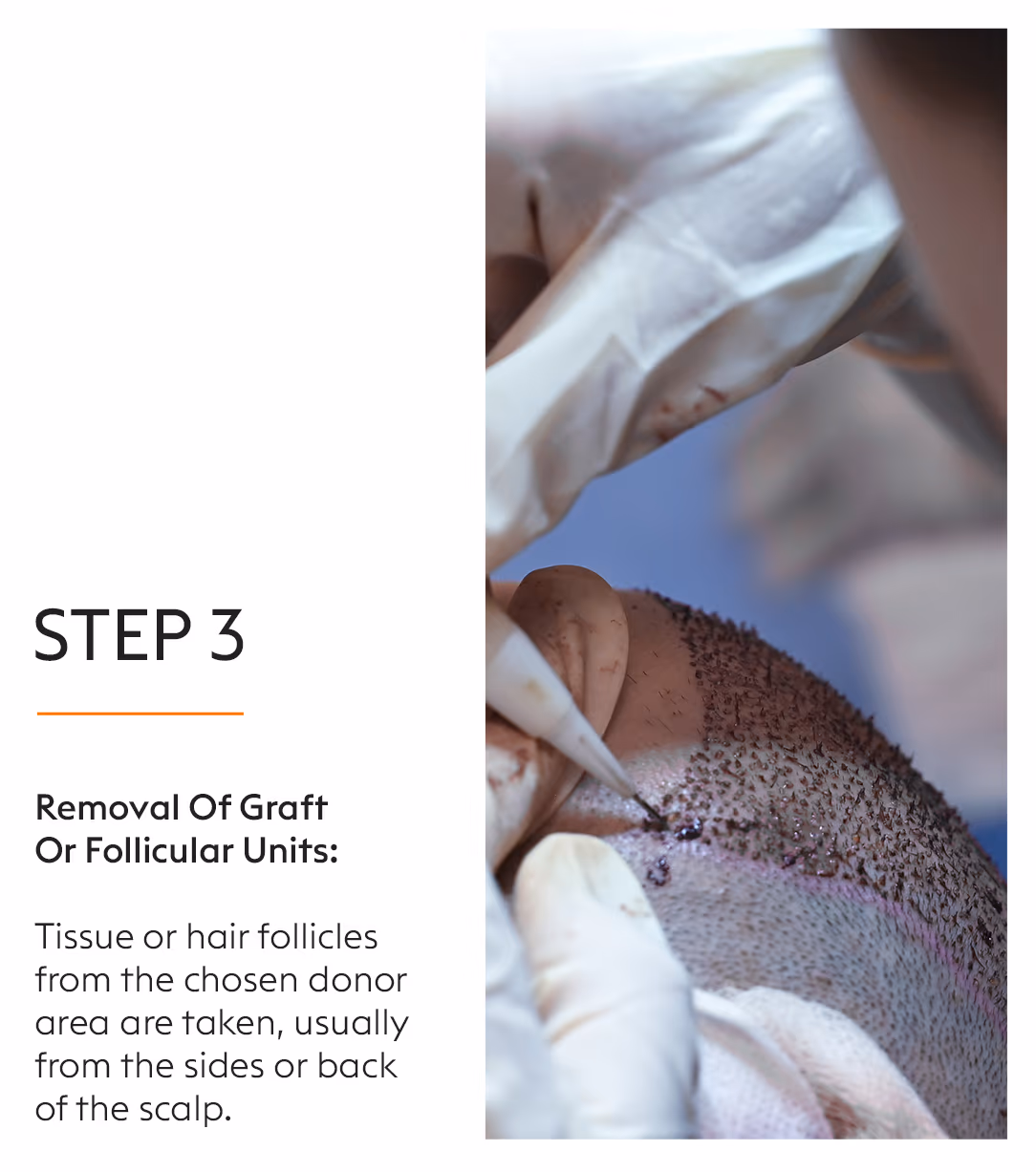 Hair Transplant Hair Fall Treatment 5