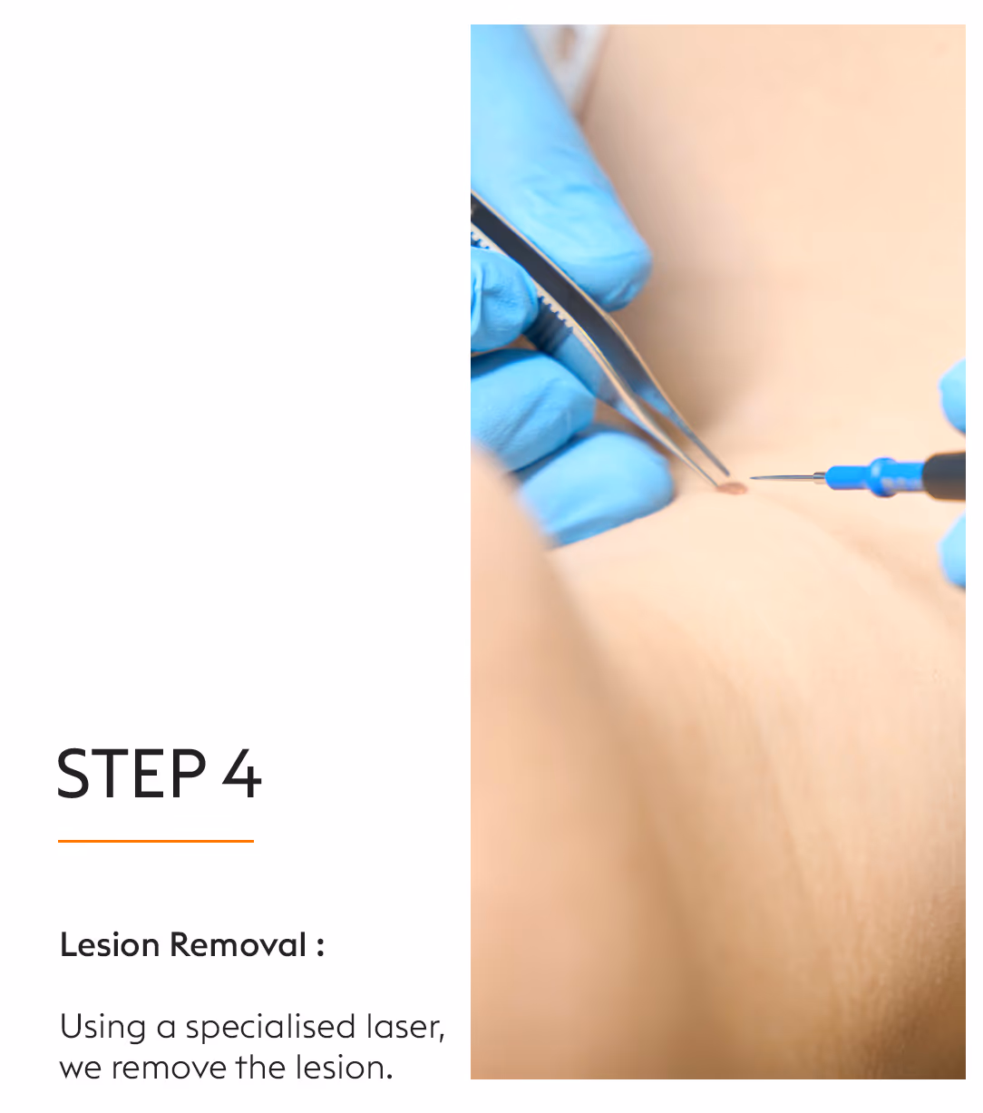 RF Electrocautery 6