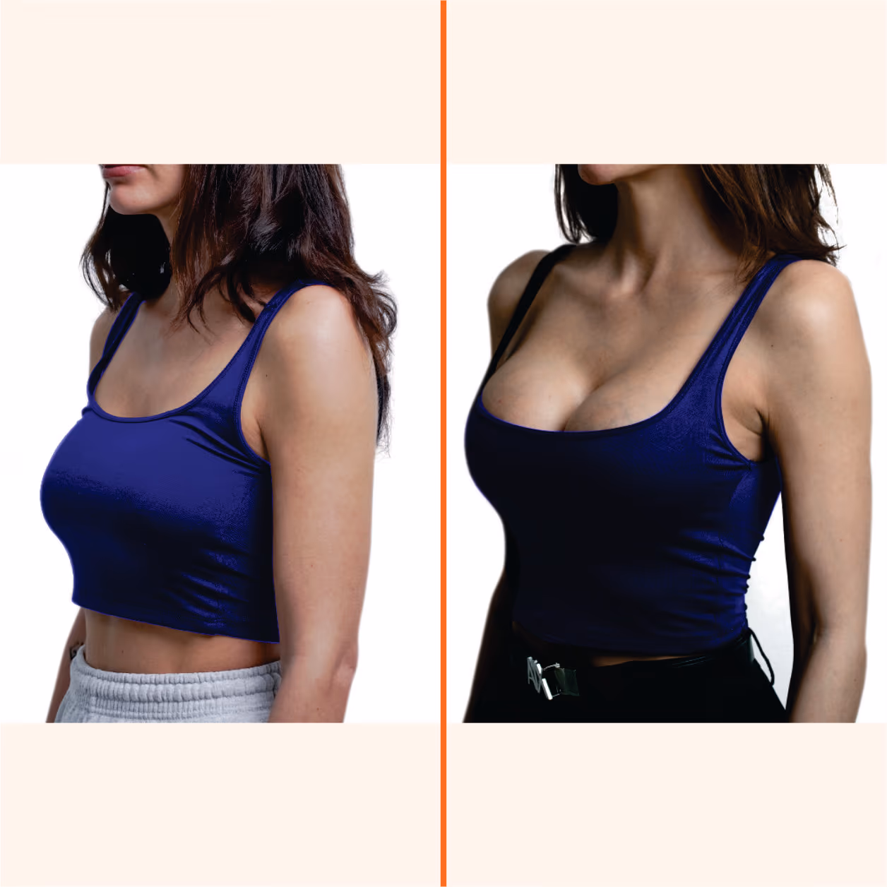 Breast Lift (Mastopexy) Surgery 2